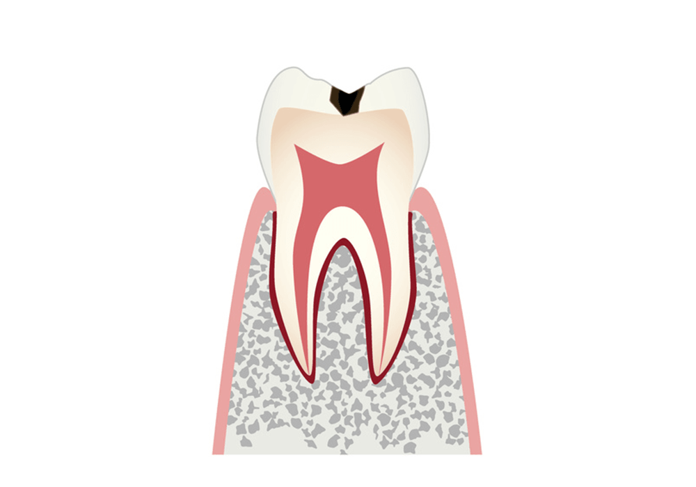 表面のエナメル質に穴が空いた虫歯