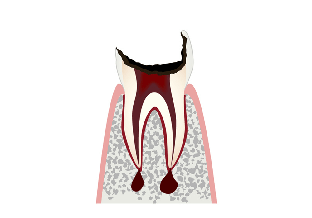 歯冠が大きく失われた歯