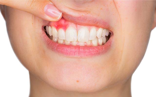歯周病の口